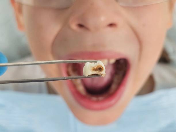 Best Emergency Root Canal Treatment in Elida, OH
